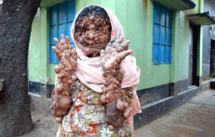 Женщина-картошка из Бангладеш, Слабонервным не смотреть!