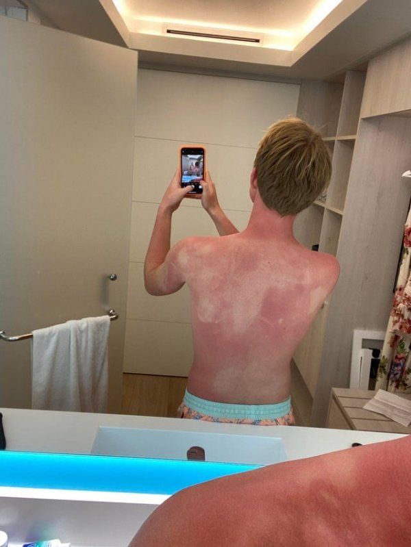 Фото приколы с неудачным Загаром людей